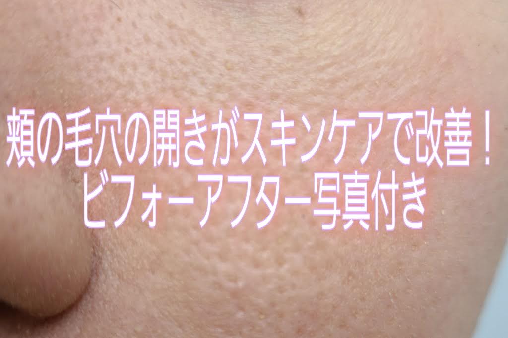 ラシュレの口コミ ビフォーアフター写真公開 頬の毛穴の開きに効果的なオイリー肌専用のオールインワンゲル うにこままのブログ