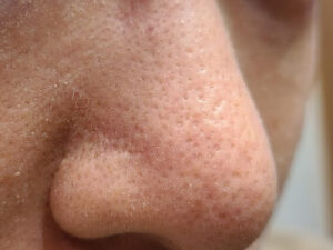 鼻の毛穴