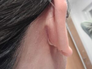 RDクリニック耳裏の傷